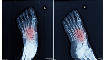 How Do Metatarsal Pads Relieve Foot Pain?